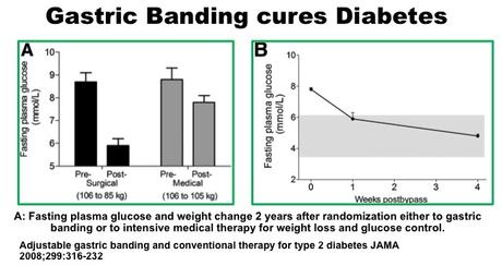 How Fasting Reverses Type 2 Diabetes
