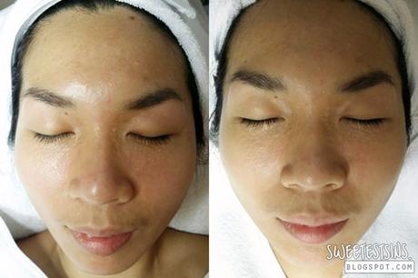 before and after indulgence beauty facial