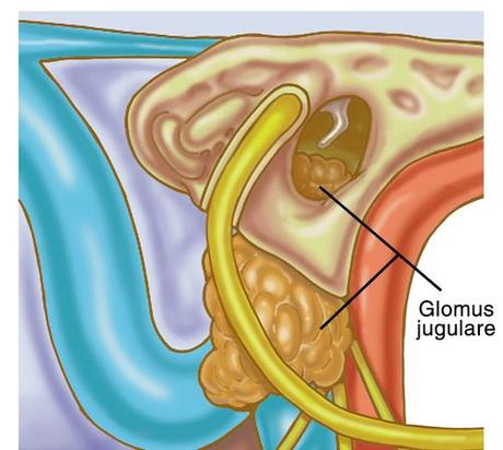 AYURVedic treatment for GLOMUS JUGULARE TUMOR
