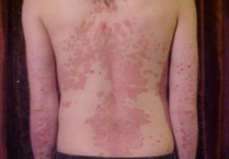 Natural Methods to cure Psoriasis-Home Remedies for Treating Psoriasis Naturally