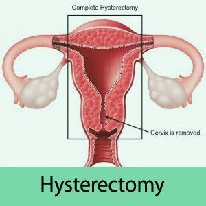 Undergo Advanced Hysterectomy Surgery at low costs in India