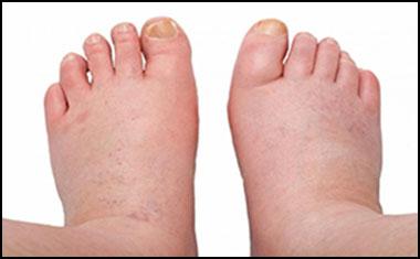 Amazing Home & Herbal Remedies for Swollen Feet