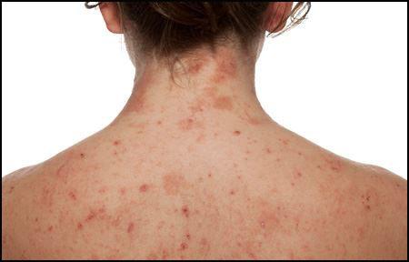 Home Remedies for Atopic Dermatitis