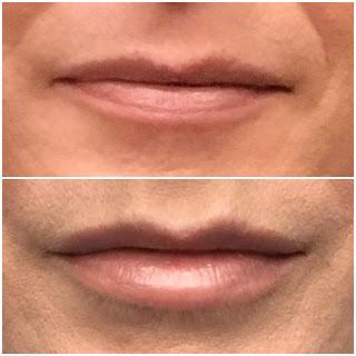 Pucker Up: A Blogger's Tale of Injectables