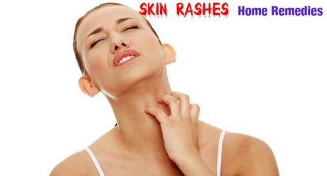 Skin Rashes Home Remedies