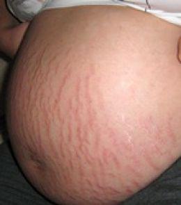 Homemade Skin Care: Get Rid of Stretch Marks
