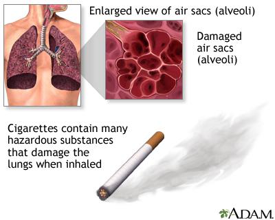Case of COPD ( Preventable Lung Disease )