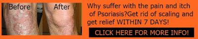 GET RELIEF FROM PSORIASIS NOW!