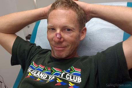 Facing up to health care Healing well, one week after the skin graft