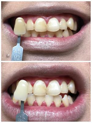 Brighten Those Yellow Stained Teeth With The Y10 System By BrightTonix