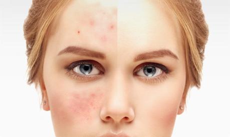 Can Keto or Low-Carb Diets Cure Acne?
