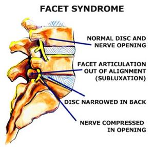 Could Your Back Pain Be Caused by Facet Joint Syndrome?