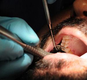 Dentist Pulls All Of Ex-Boyfriend's Teeth Out After Getting Dumped