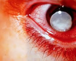 Don’t let glaucoma rob you of your sight Don’t let glaucoma rob you of your sight