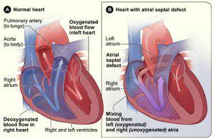 What Congenital Heart Defects Might My Family of Women Suffer From?