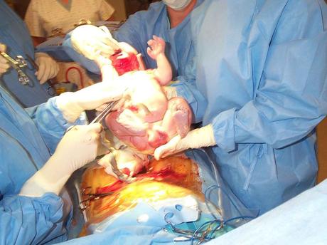 A Caesarean section in progress. Caesarian1 Why I Choose A Planned C Section