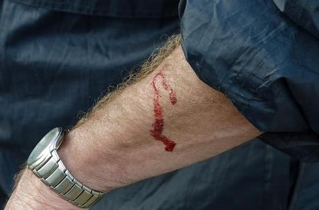 Random bleeding bleeding arm