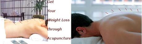 Weight Loss Through Acupuncture