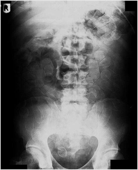 X-ray of swallowed cocaine-filled balloons