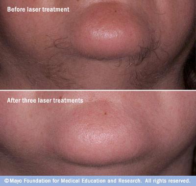 Photo showing before-and-after results of laser hair removal
