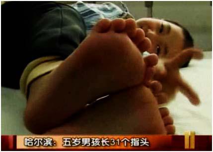 Amazing Baby Born With 34 Fingers - New World Record Amazing Baby Born With 34 Fingers - New World Record 2