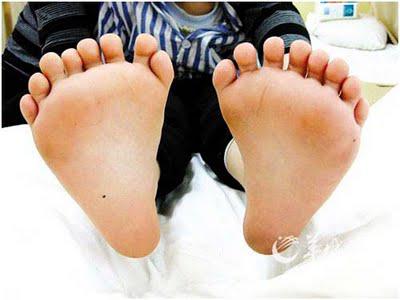 Amazing Baby Born With 34 Fingers - New World Record Amazing Baby Born With 34 Fingers - New World Record 3