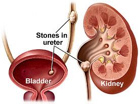 kidney stones