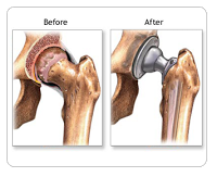 Ways to Know of the Hip Replacement Surgery