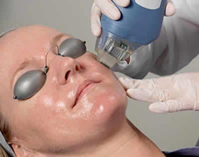 woman having laser treatment