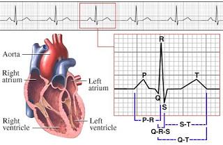 Commonly Known as a Heart Attack