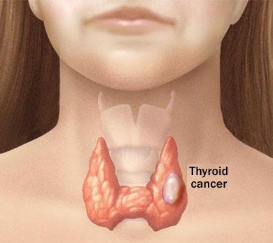 Thyroid Cancer 