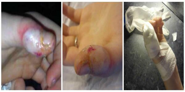 PicMonkey Collage7 Paronychia Finger Pulp Infection Causes Kate Pain
