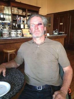 Riot Police Raid Gezi Gardens and Evict Treesits Protester received a black eye from SFPD
