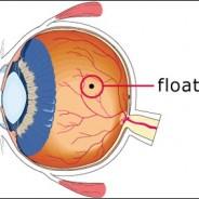 Eye Floaters: Causes, Symptoms, and Treatment