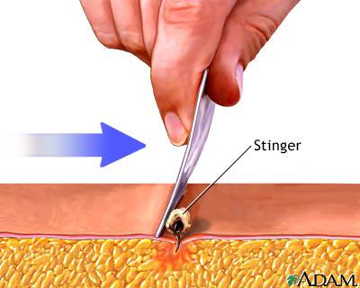 Survive Outdoor:First Aid on Insect and Sting Bite Survive Outdoor:First Aid on Insect and Sting Bite
