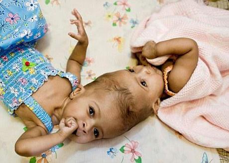 Facing the World Medical Team separates Twins joined at the head
