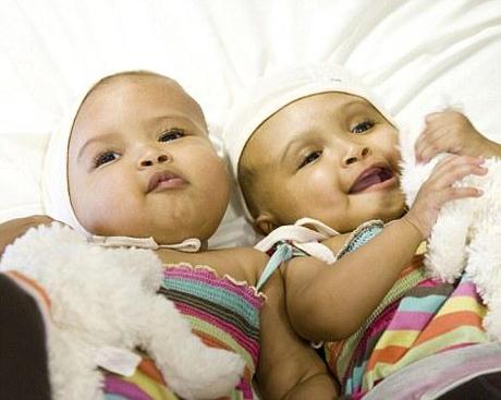 Facing the World Medical Team separates Twins joined at the head