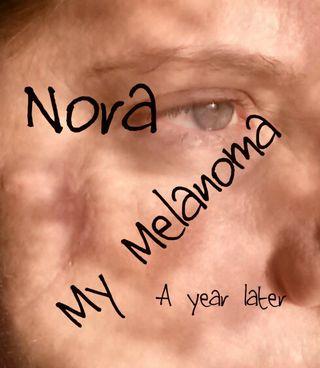 Nora a year later for blog