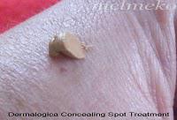 Treatment Products – Pimples! Treatment Products – Pimples!