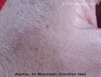Treatment Products – Pimples! Treatment Products – Pimples!