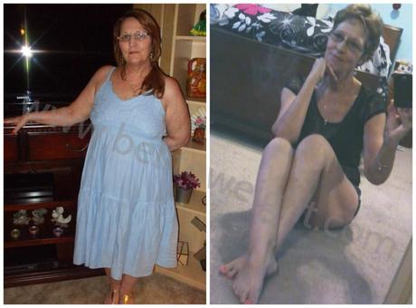 Medicare Paid Gastric Bypass Surgery – Brenda’s Weight Loss Story