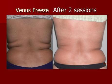 Venus Freeze Treatment (9)