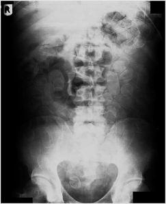Ballons x-ray The Man Who Swallowed the Diamond