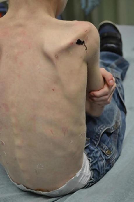 5 Yr Old Starved, Locked in Closet, Skin Peeling And In A Diaper (Disturbing Video)