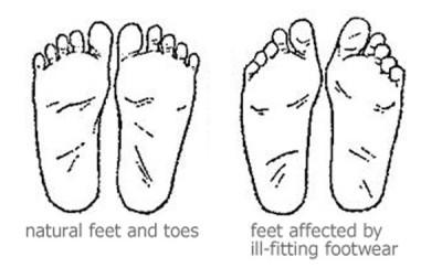 A Minimalist Miracle? Correct Toes May Prevent, Treat and Cure Foot Injuries Without Surgery