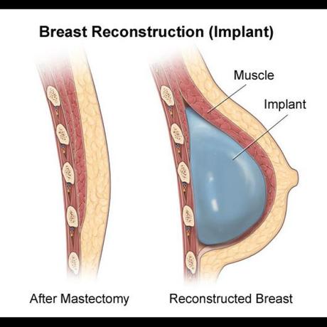 reconstruction