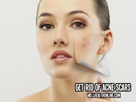 Get Rid of Acne Scars Before They're Permanent