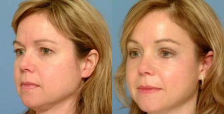 Brow Lift (Forehead Lift) Surgery - Before & After