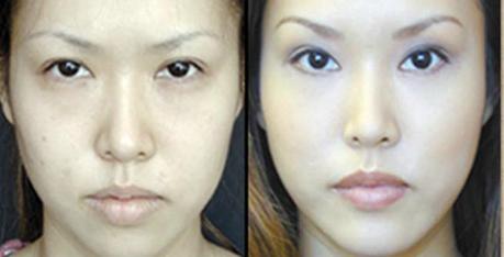 Asian Blepharoplasty Asian Blepharoplasty