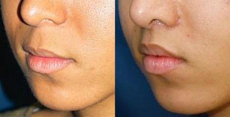 Lip Lifting Surgery Before & After Lip Lifting Surgery Before & After